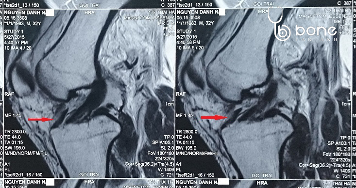 Chụp cộng hưởng MRI