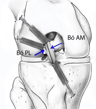 MỔ TÁI TẠO DÂY CHẰNG CHÉO SPORTS MEDIC