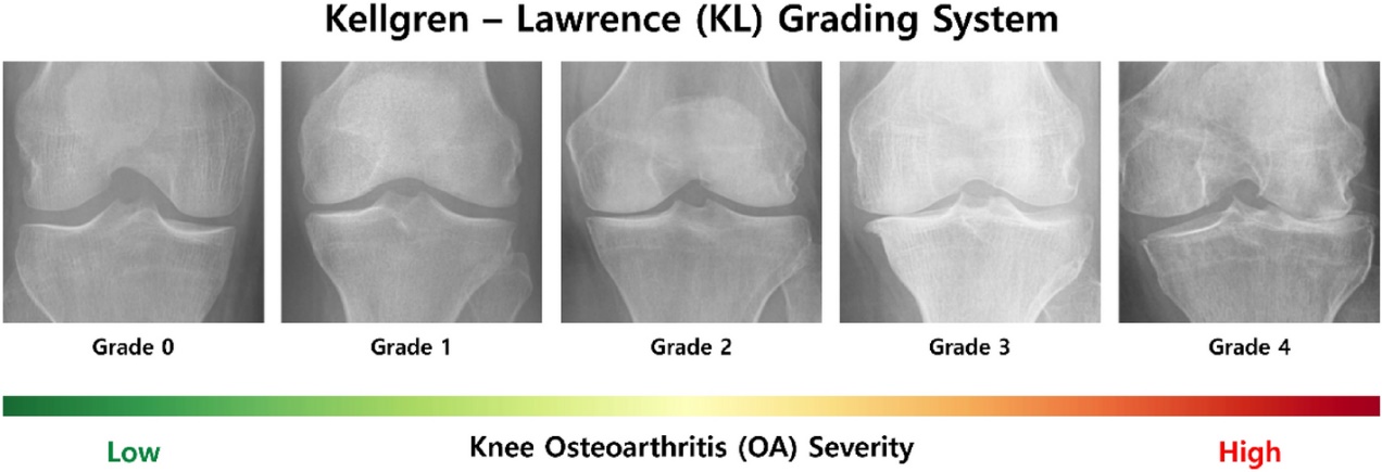 Ensemble deep-learning networks for automated osteoarthritis grading in knee X-ray images | Scientific Reports