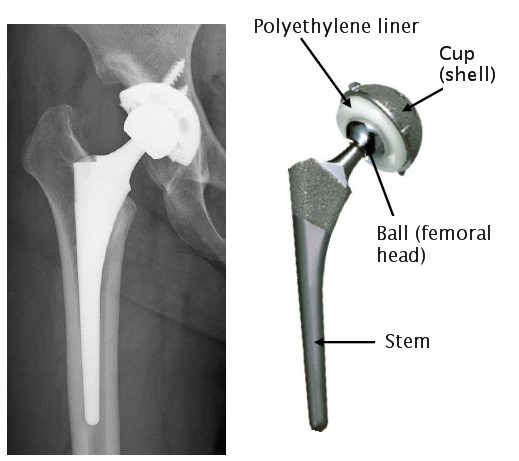 Long-life artificial hip joint reaches the bedside | The University of Tokyo