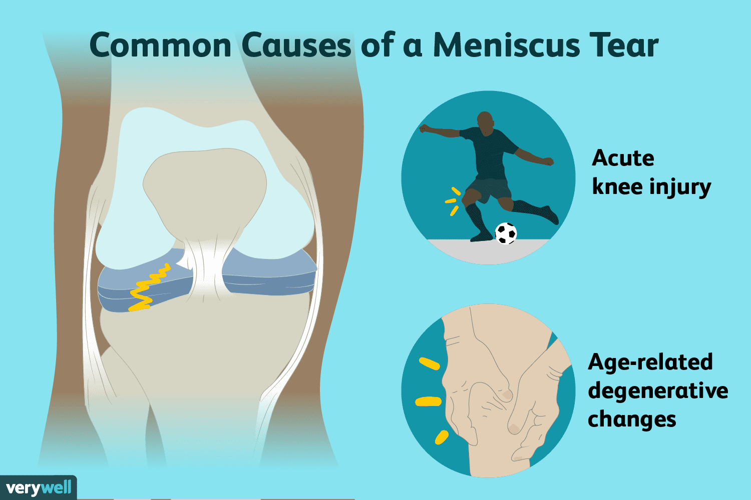 Meniscus Tears: Symptoms, Causes, Diagnosis, Treatment