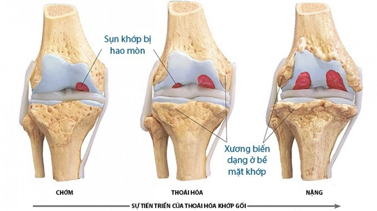 Nguyên nhân thoái hóa khớp gối và ai là đối tượng nguy cơ?