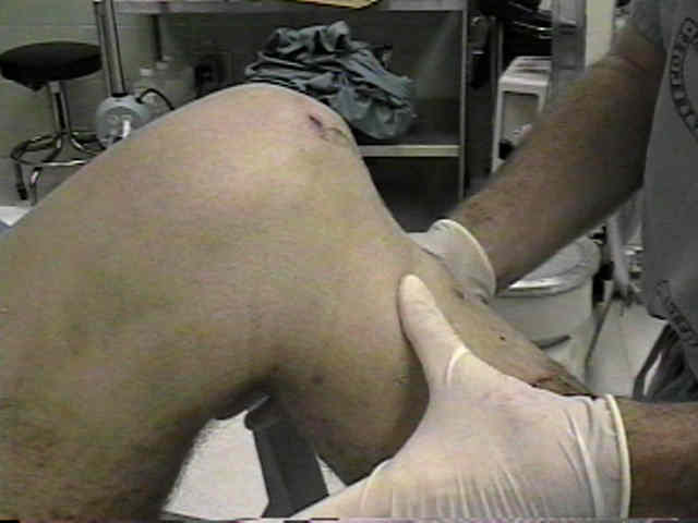 Posterior Cruciate Ligament : Wheeless' Textbook of Orthopaedics