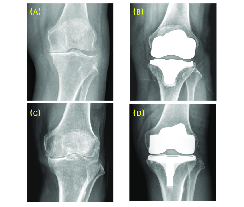 Radiographic images before and after surgery using MP and PS... | Download Scientific Diagram