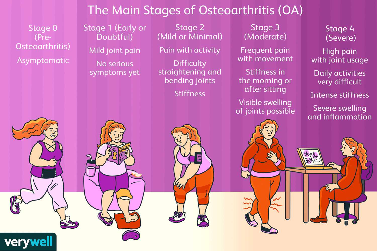 The 4 Stages of Osteoarthritis: Symptoms and Treatment